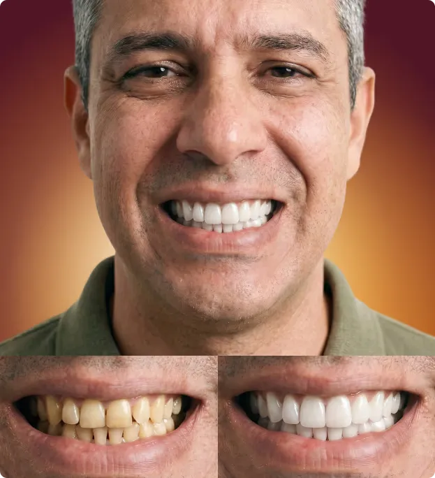 Implantes