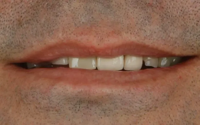 Antes: Carlos Eduardo, sorriso