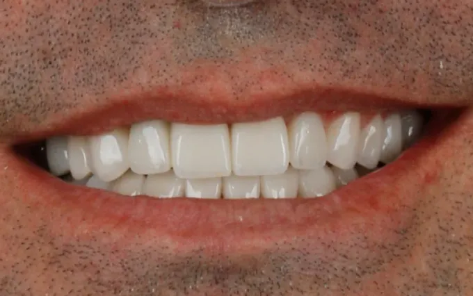 Depois: Carlos Eduardo, sorriso