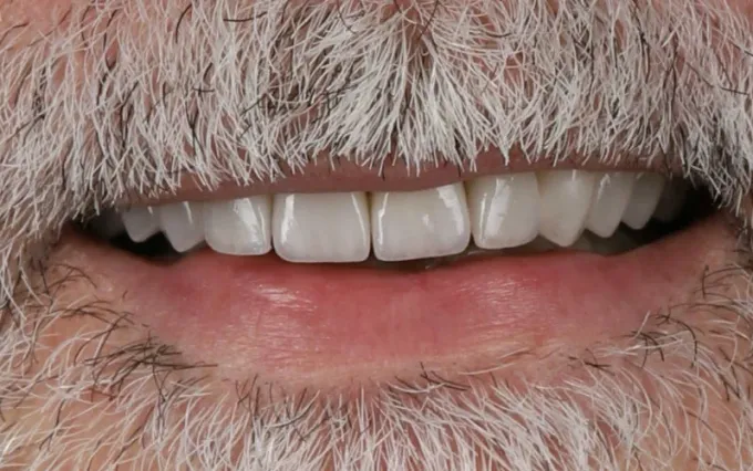 Depois: Carlos Pereira, sorriso