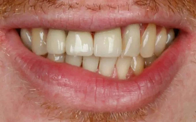 Antes: Kenny Chevalier, sorriso