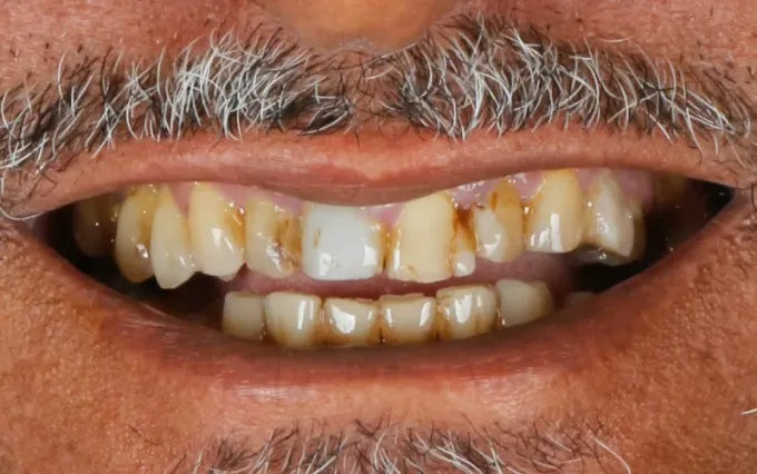 Antes: Luis Claudio, sorriso