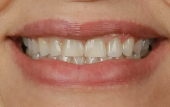 Antes: Marcia Ximenes, sorriso